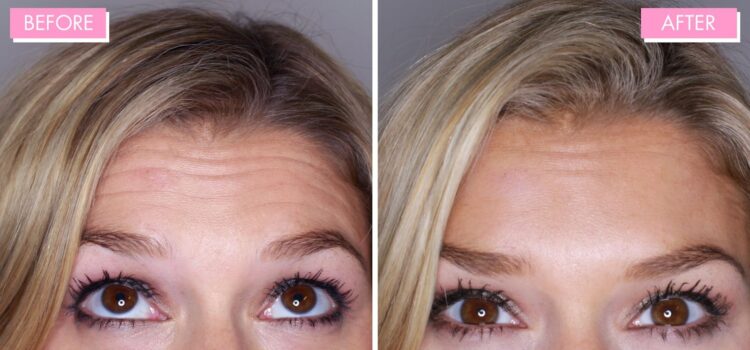 Understanding Botox: Is It the Ultimate Solution for Facial Wrinkles?
